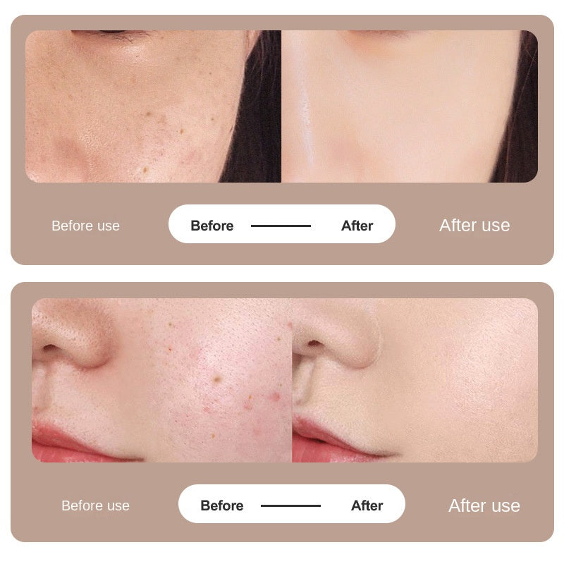 Stylo Scanner Laser LCD pour Grains de Beauté - Appareil Professionnel Anti-Âge